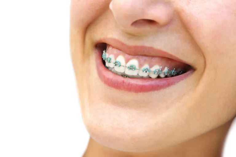 33764 braces and teeth