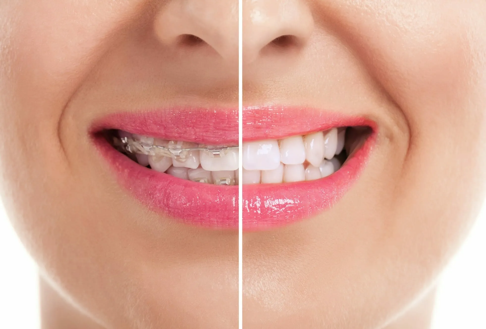 33764 teeth whitening after braces 2