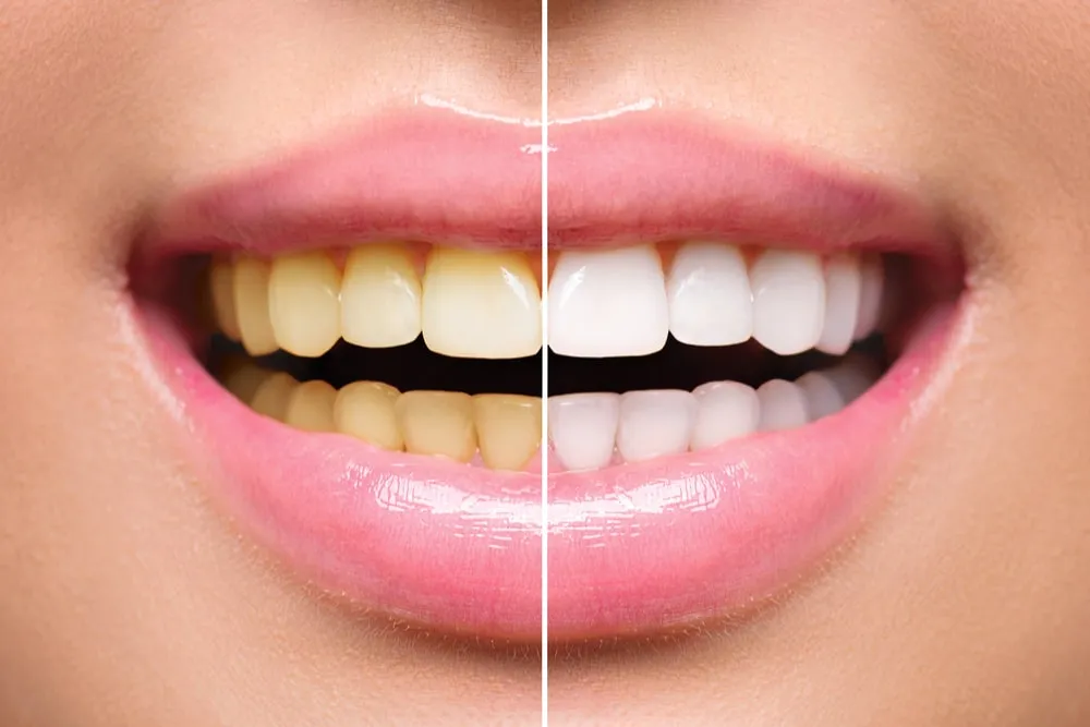 33769 teeth whitening orlando park custom trays