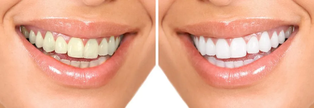 33769 teeth whitening orlando park foods to avoid