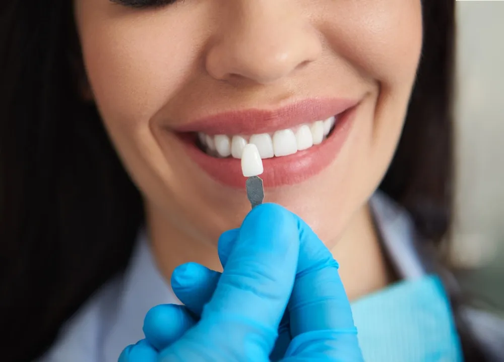 33769 teeth whitening orlando park professional treatment