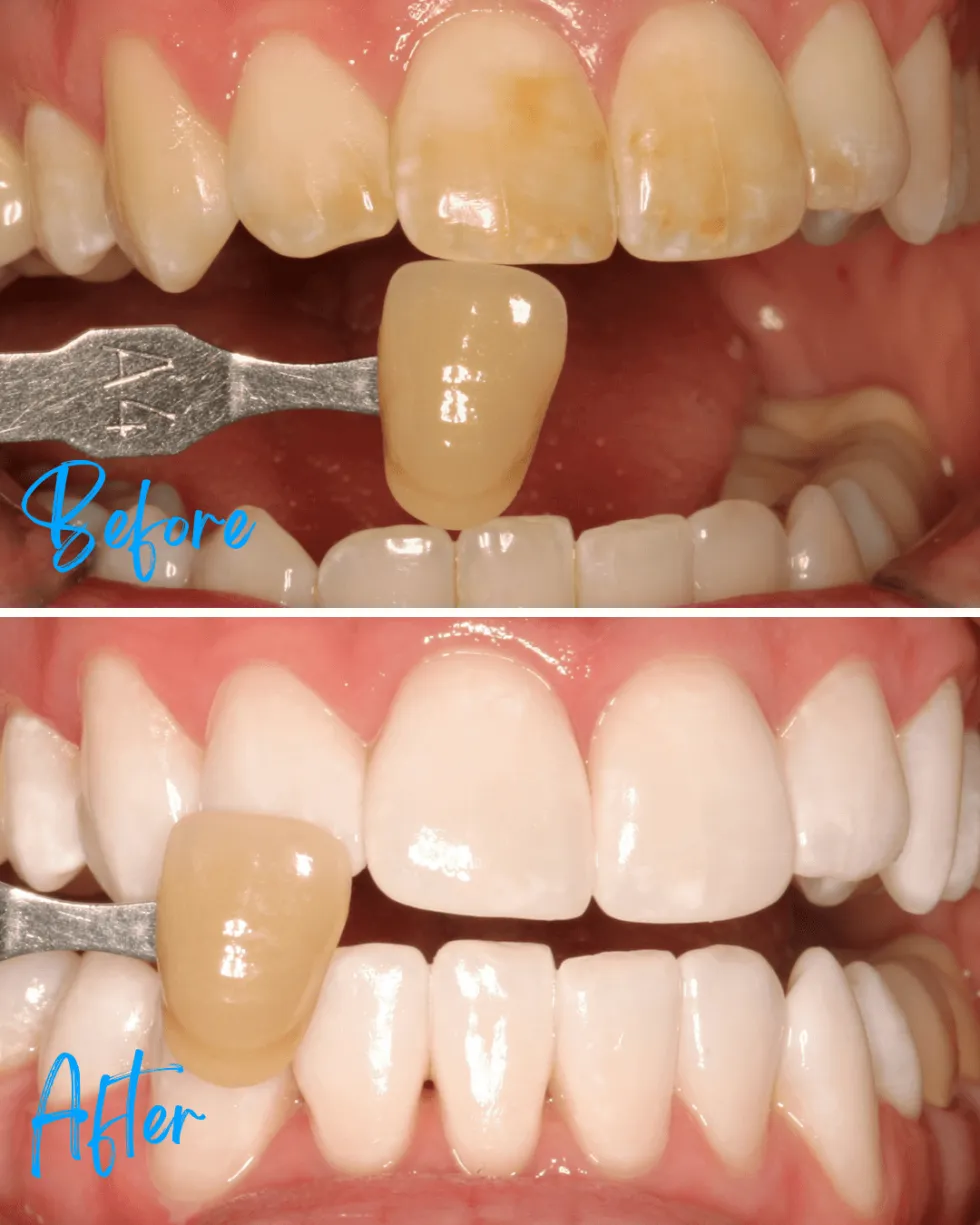 33771 kor whitening before after