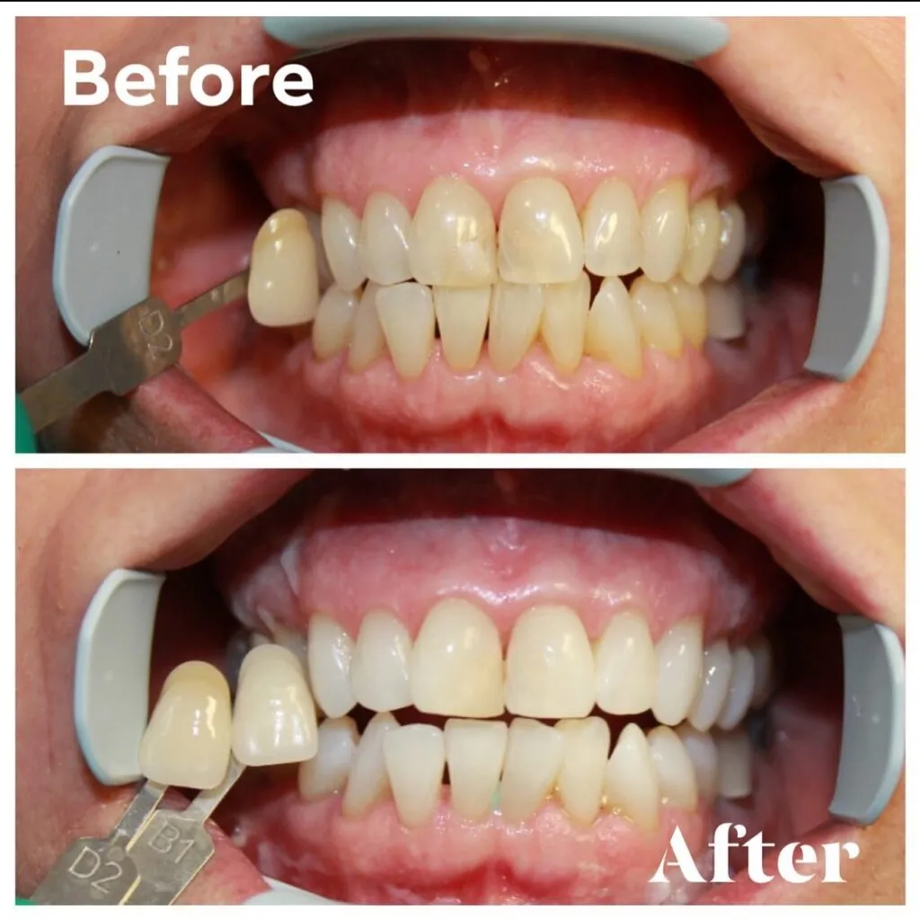 33771 teeth whitening comparison
