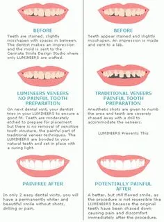 33772 lumineers whitening cost