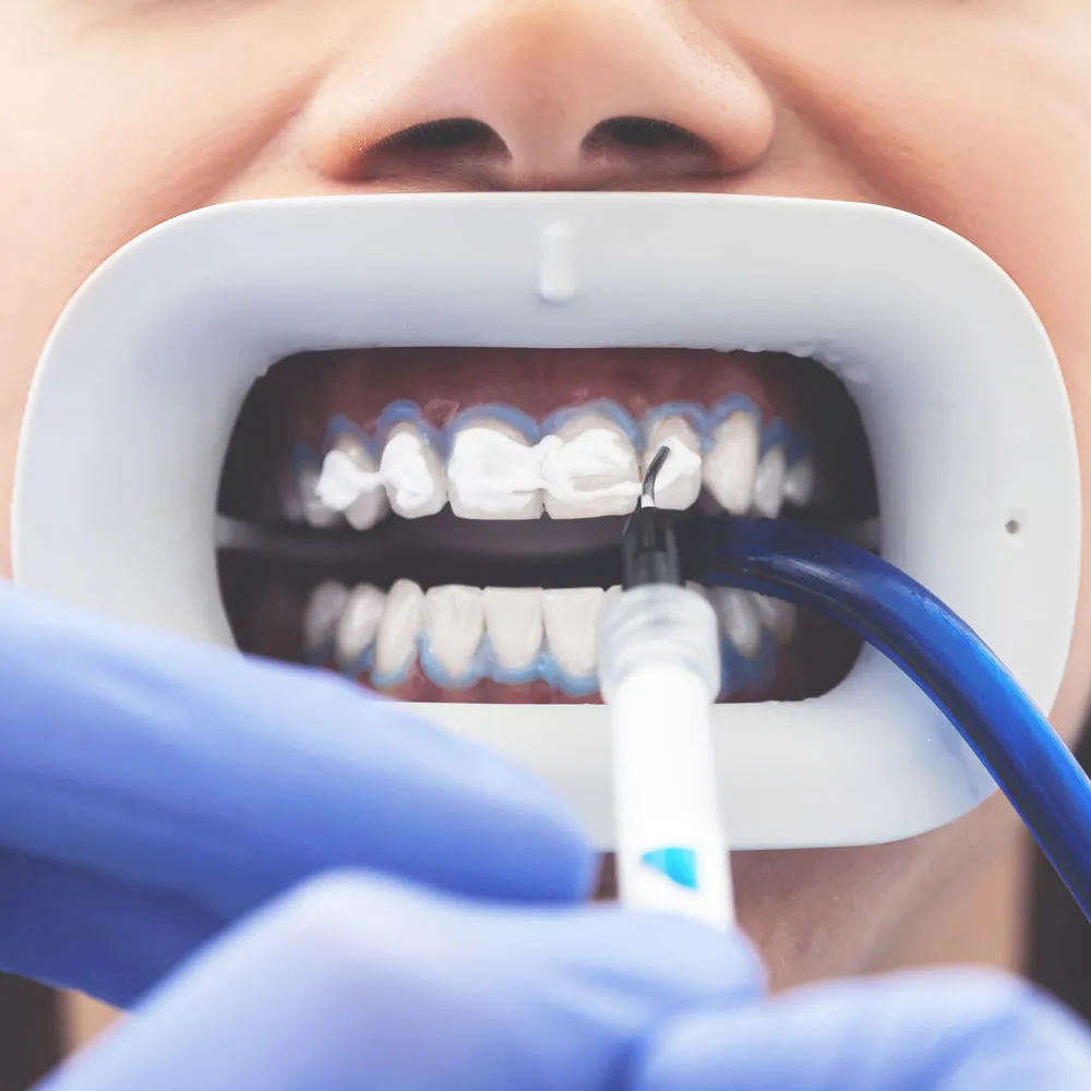 33778 smile makeover washington dc