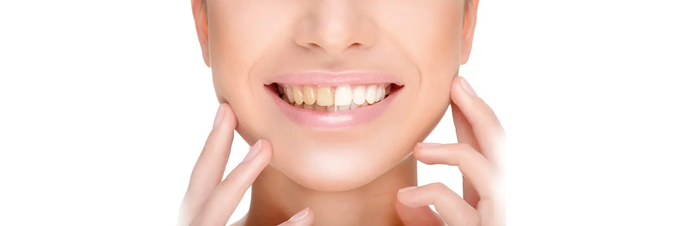 33780 professional teeth whitening