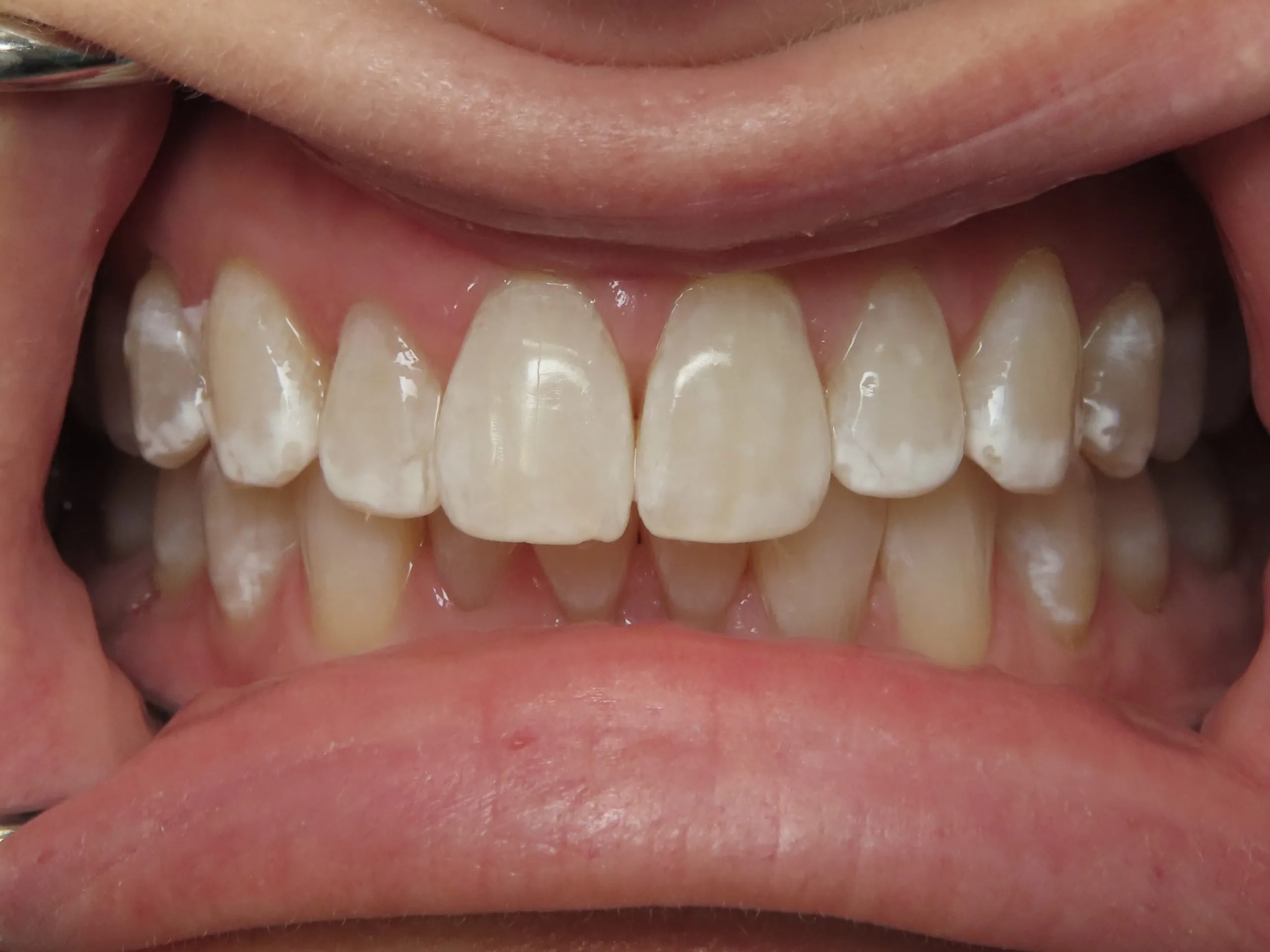 33782 office whitening procedure