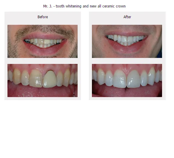 33783 diy tooth whitening