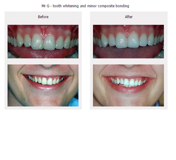 33783 professional tooth whitening