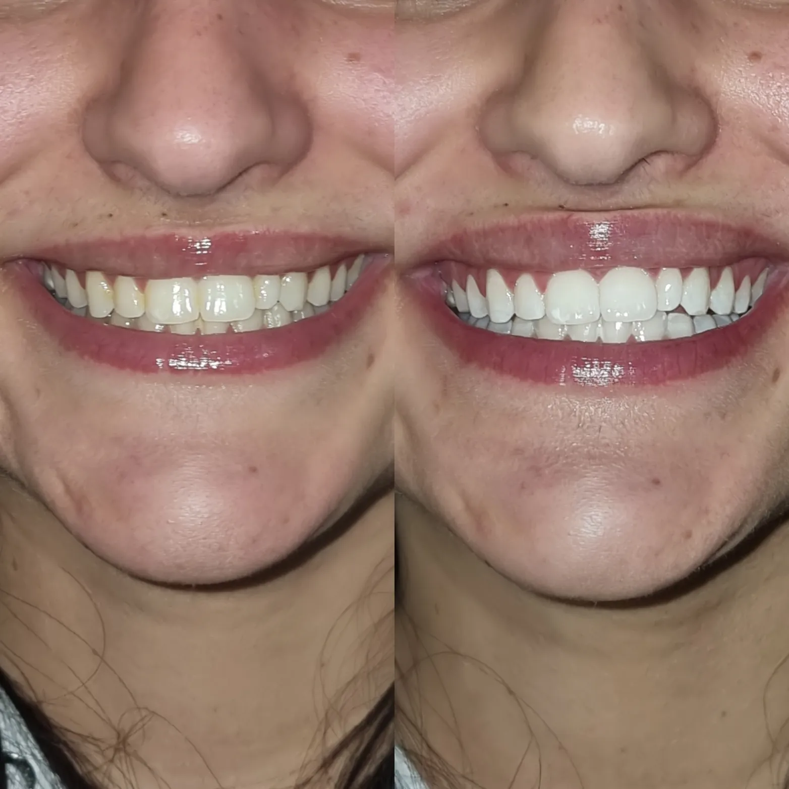 33788 professional teeth whitening
