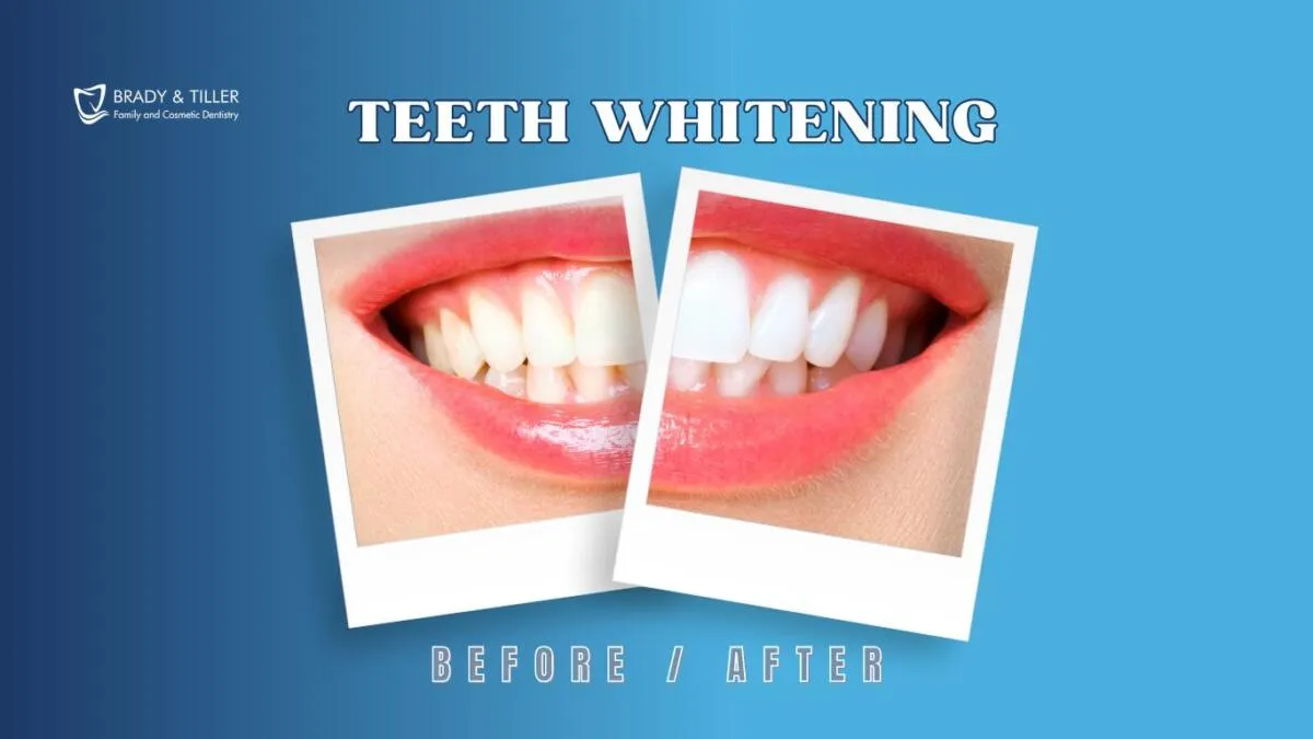 33789 teeth whitening hickory nc healthy teeth