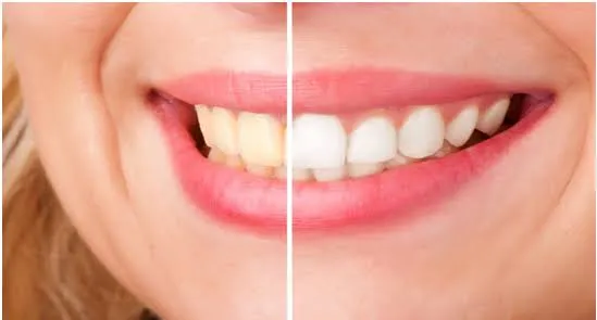 33793 instant teeth whitening