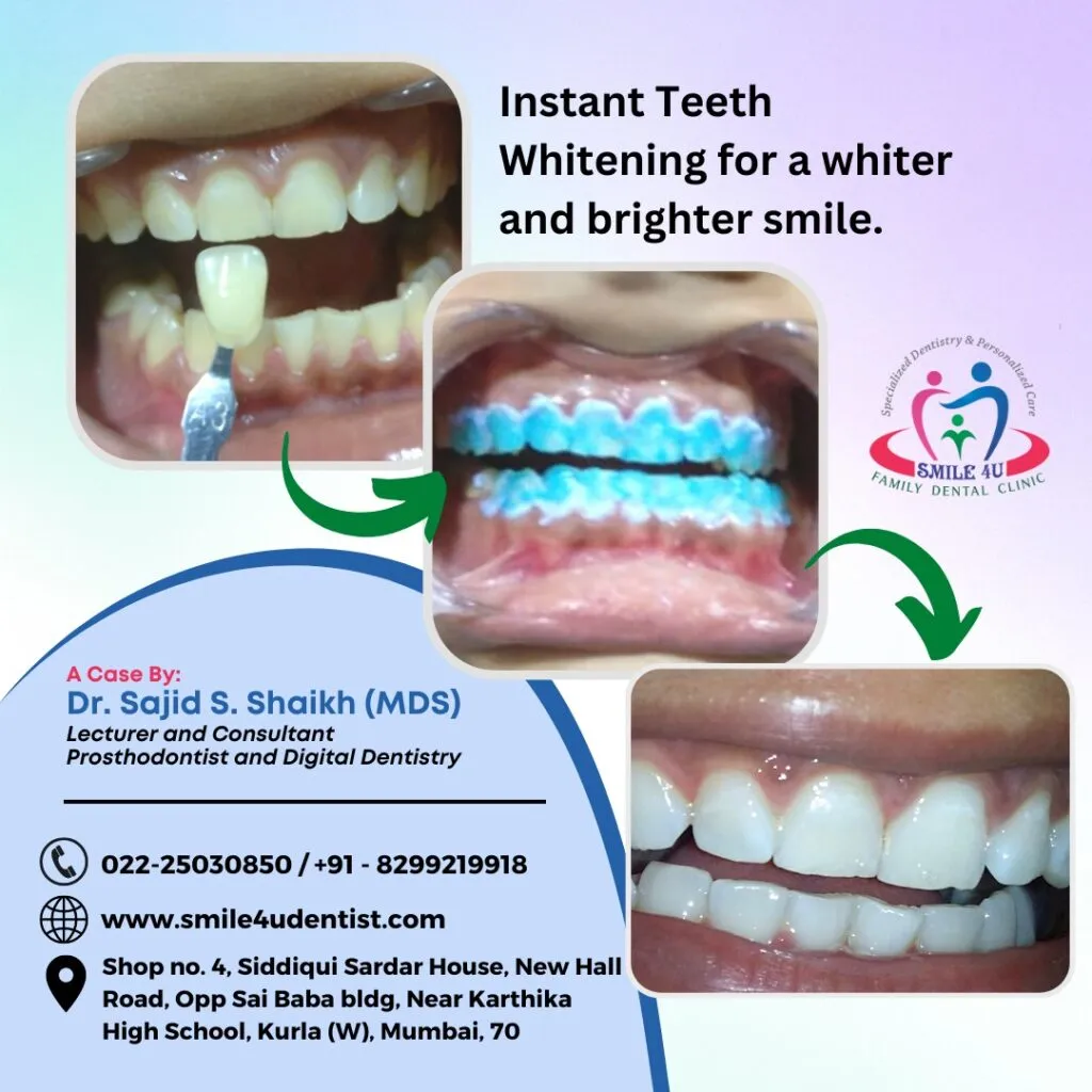 33793 whitening strips