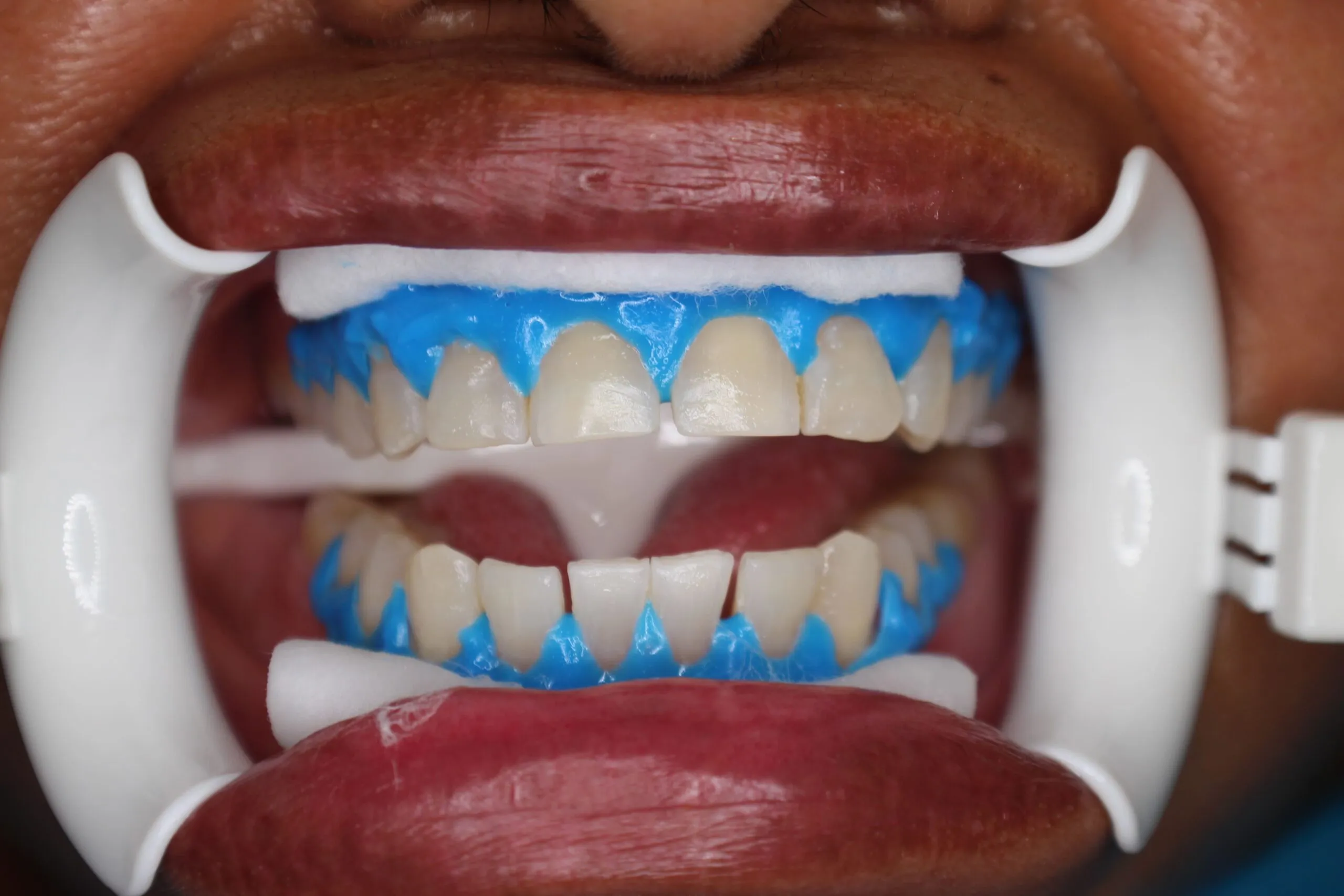 33795 teeth whitening process