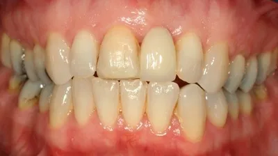 33795 whitening toothpastes