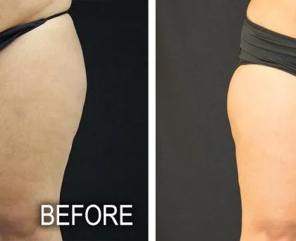 33796 laser inner thigh whitening machine