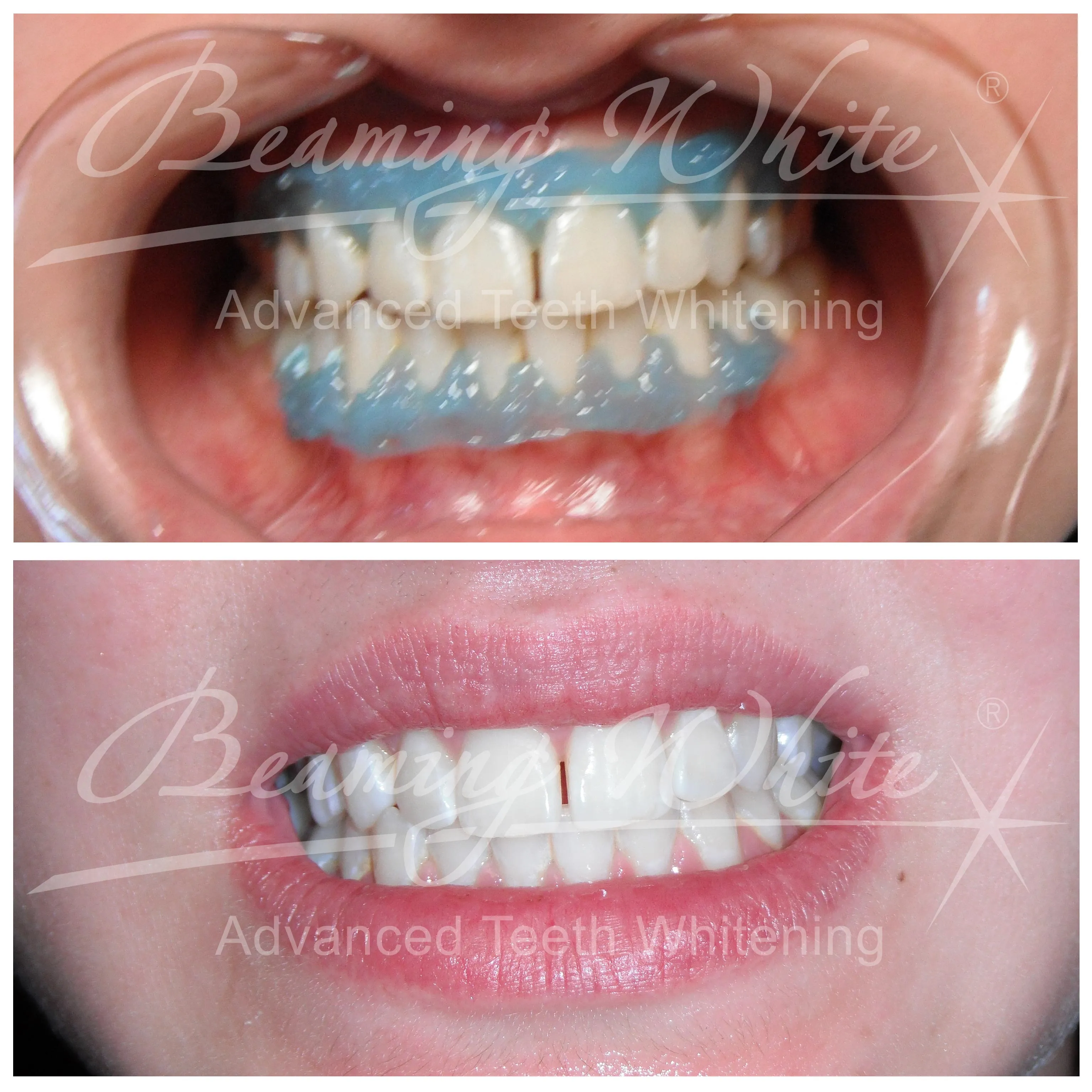33801 in office teeth whitening