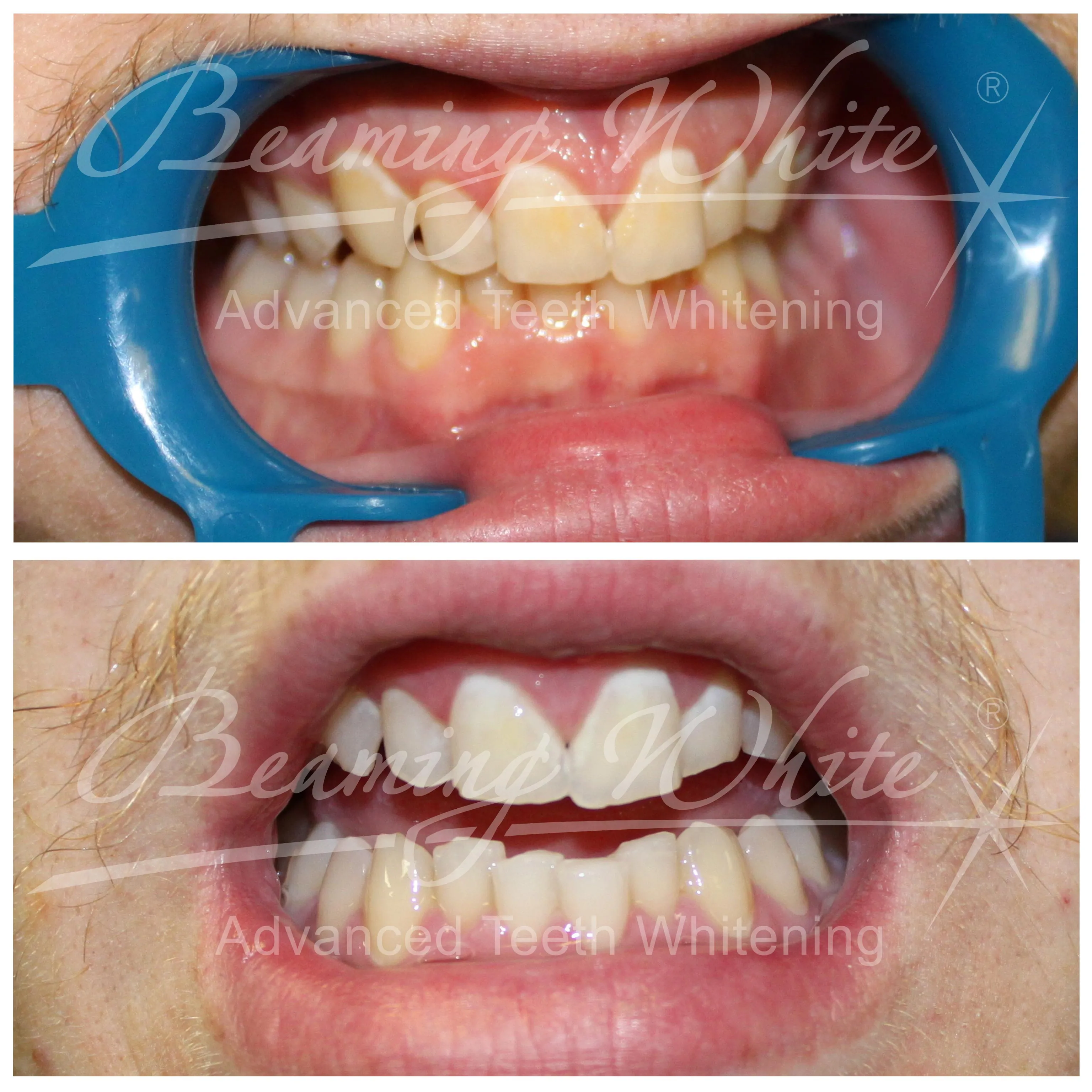 33801 teeth whitening procedure