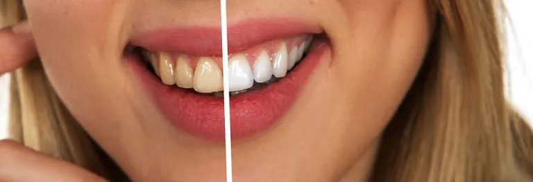 33810 teeth whitening options