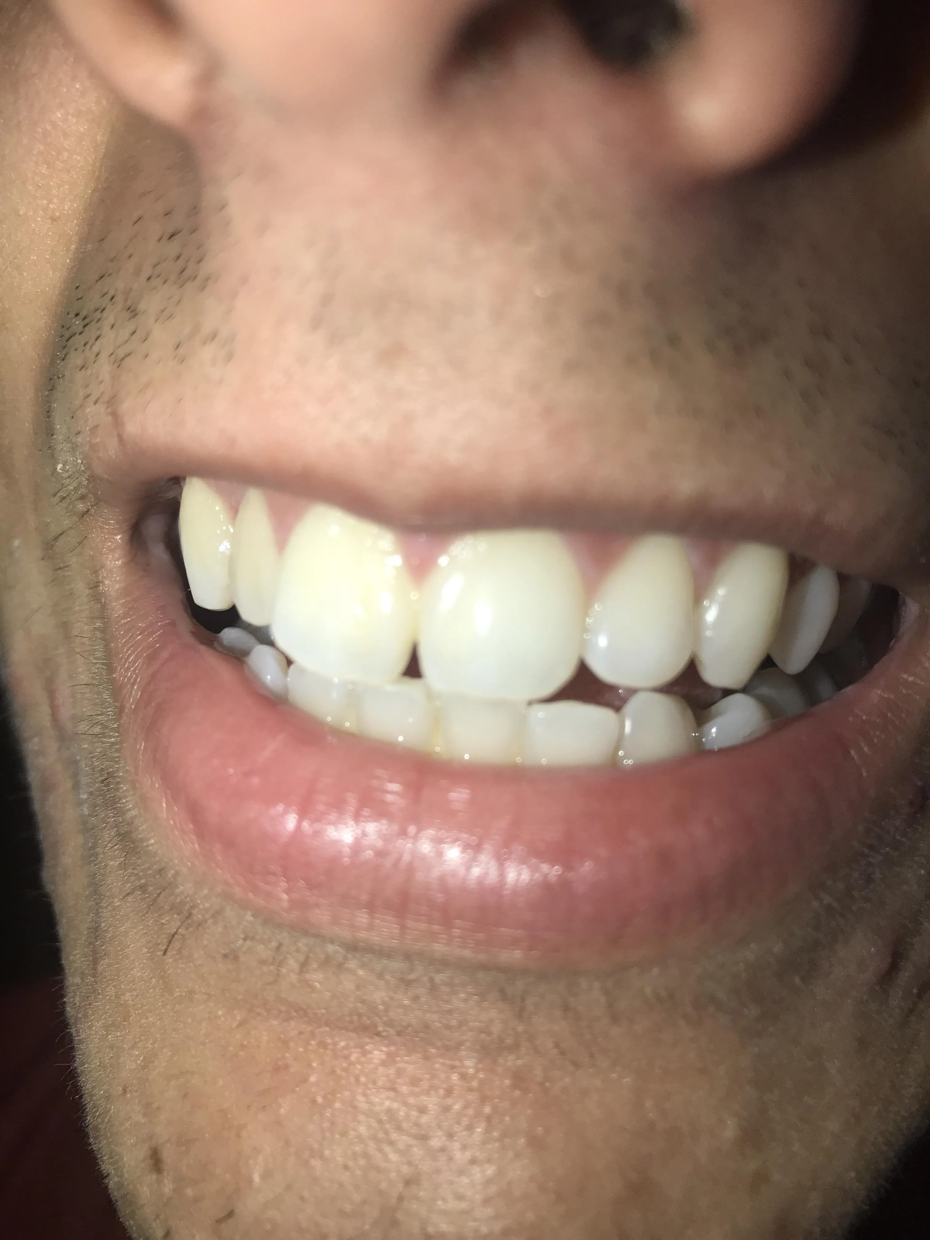 33813 professional whitening