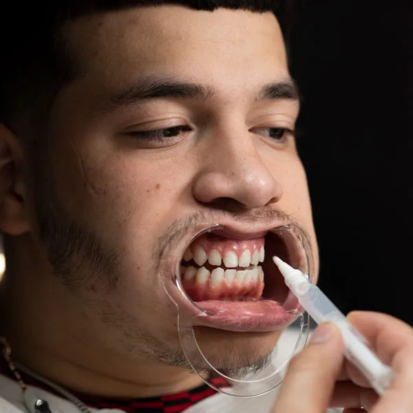 33824 teeth whitening midland tx before after