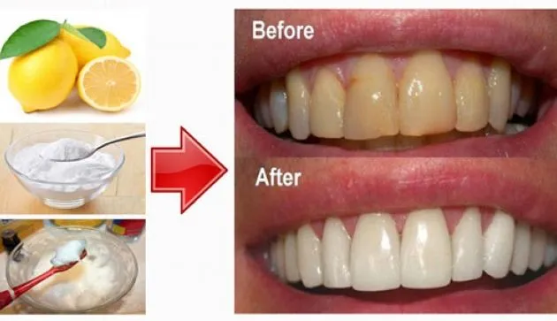 33828 lemon tooth enamel damage