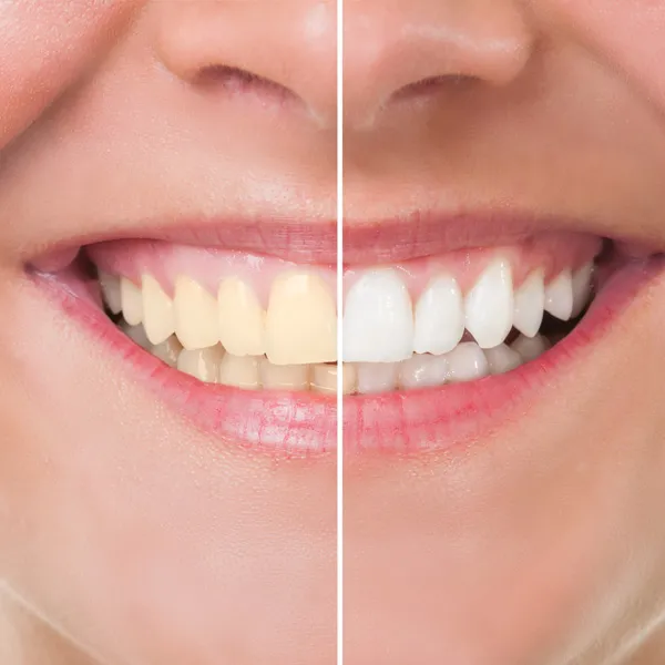 33830 teeth whitening process