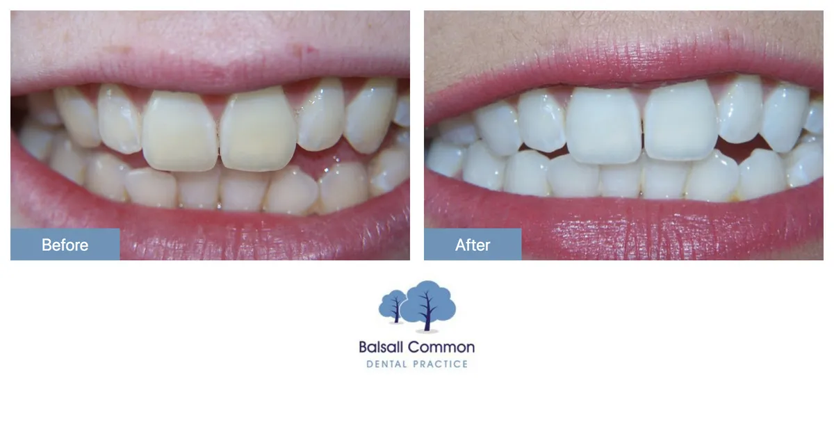 33832 professional vs diy whitening