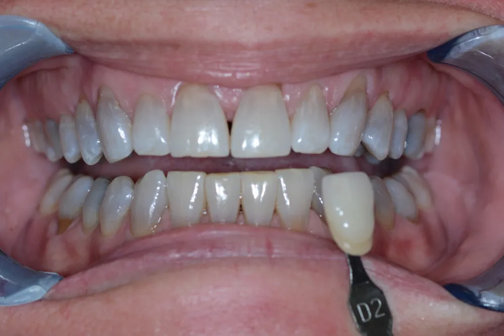 33860 stained teeth foods