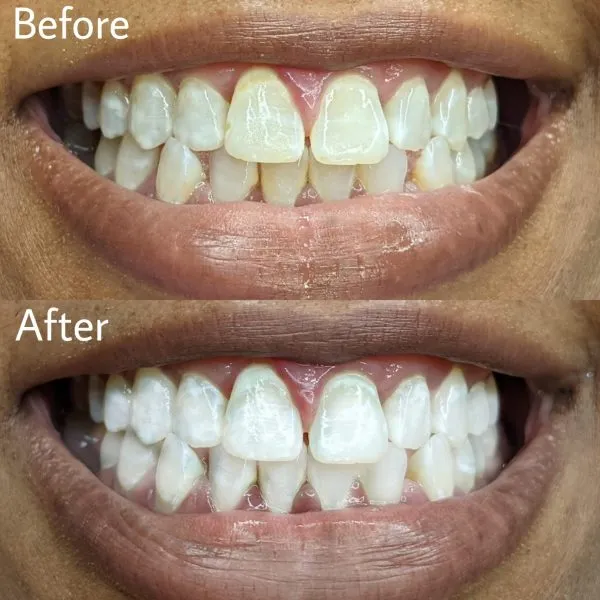 /img/33866-affordable-teeth-whitening-tips.webp