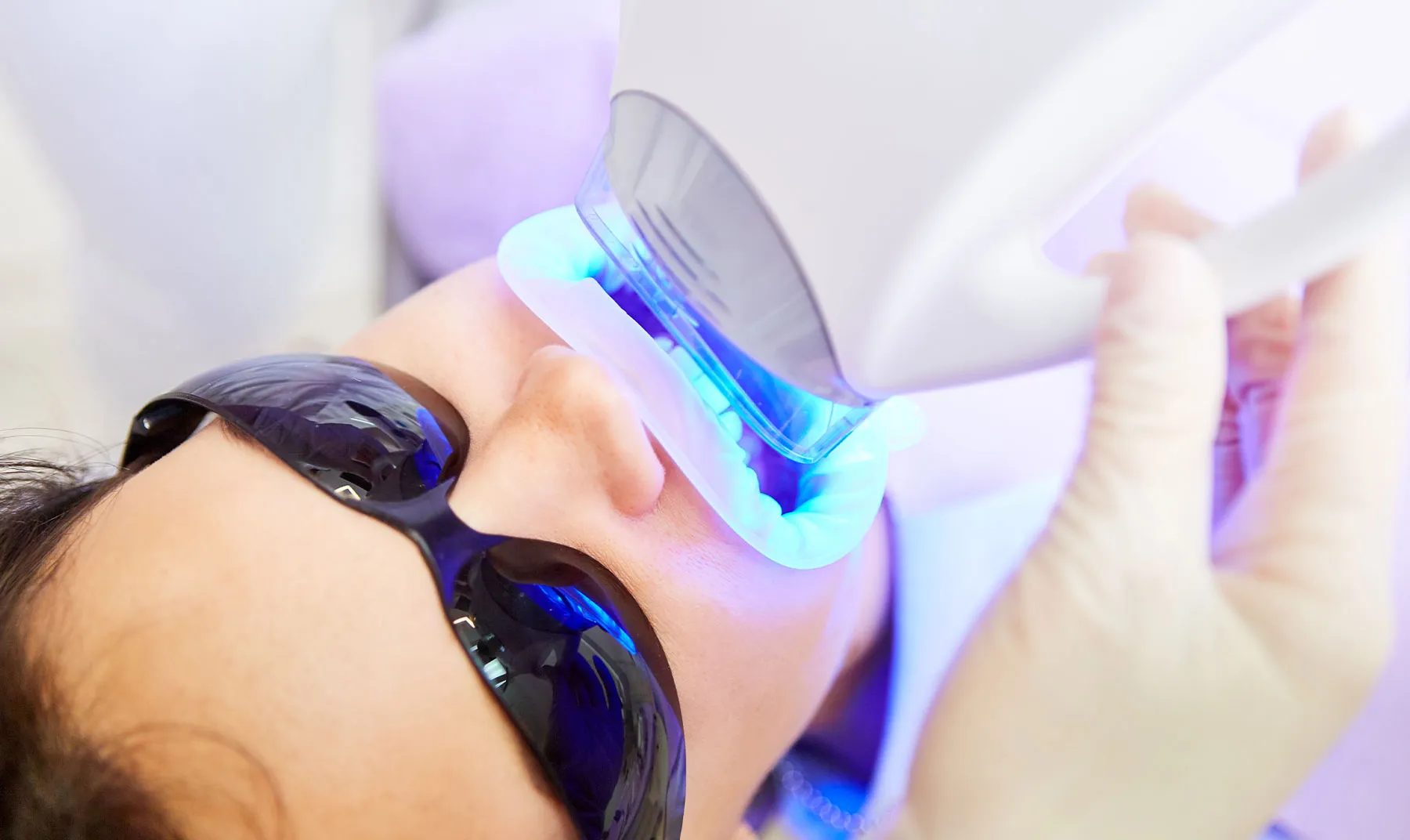 33866 at home teeth whitening kits