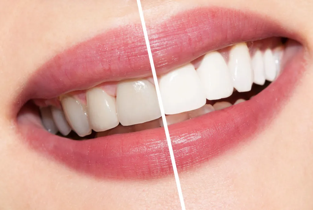 33866 teeth whitening process