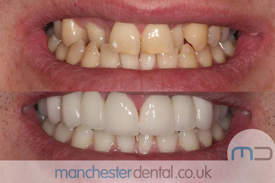 33869 laser teeth whitening manchester city centre procedure