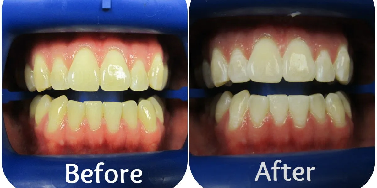 33871 gum irritation