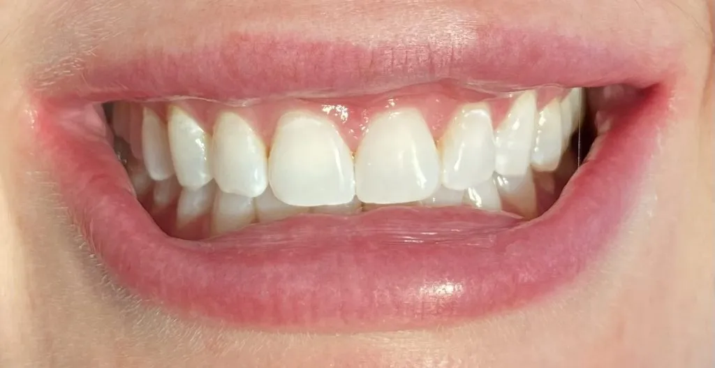 33871 post whitening care