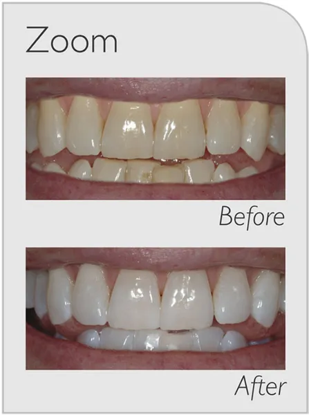 33871 zoom teeth whitening