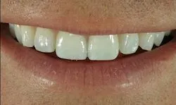33874 teeth whitening cost columbia sc