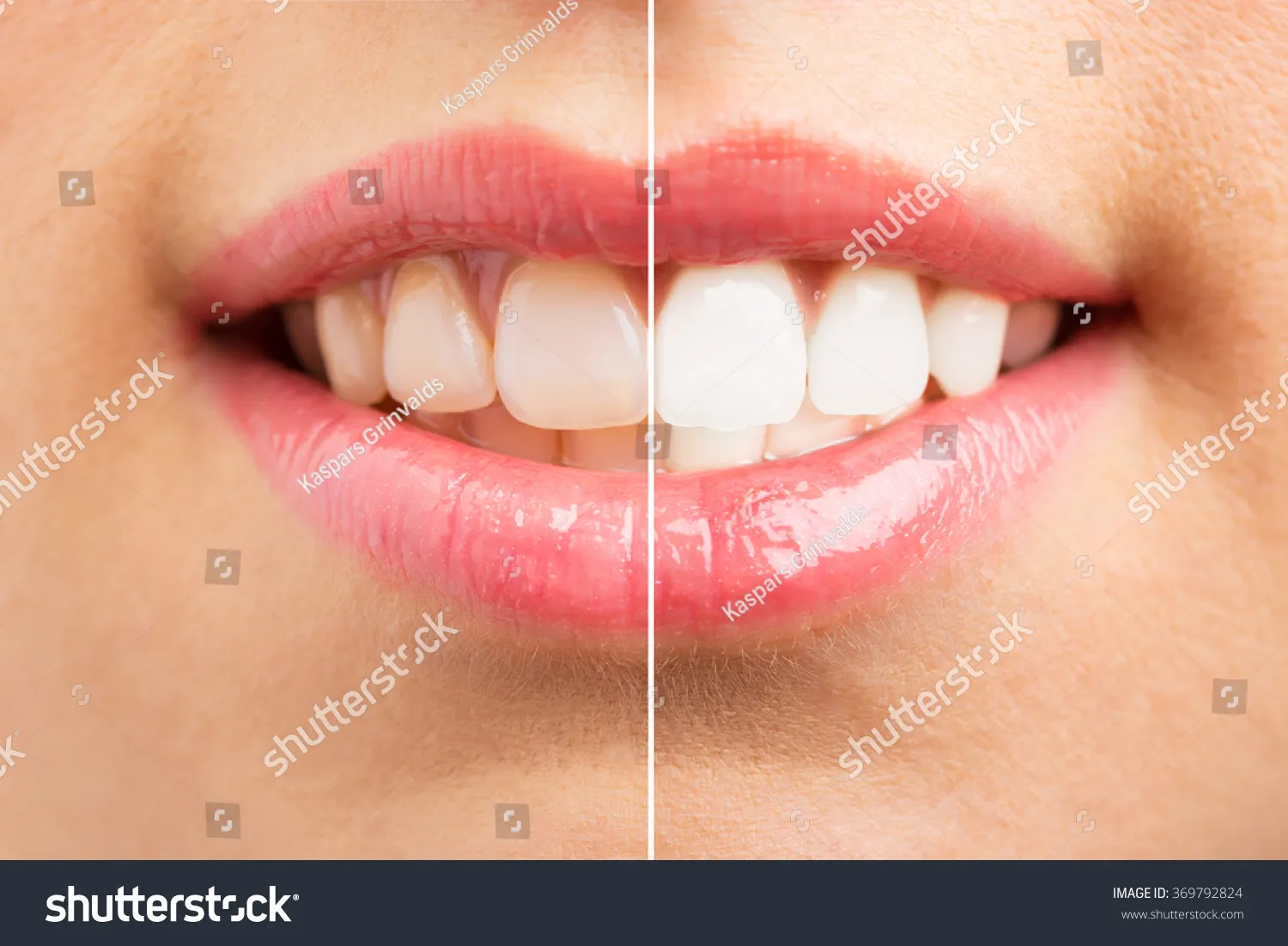 33883 over the counter whitening