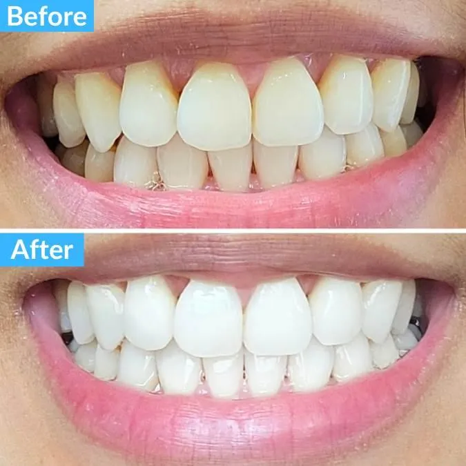 33886 at home teeth whitening