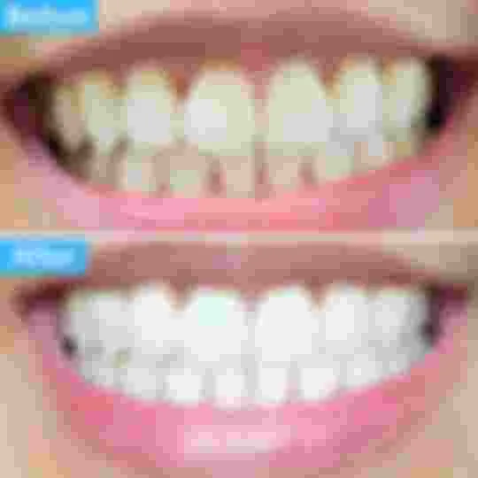 33886 teeth whitening maintenance