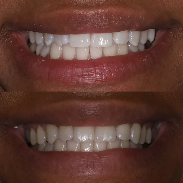 /img/33892-teeth-whitening-wilmington-nc-7.webp