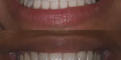 /img/33892-teeth-whitening-wilmington-nc-7.webp