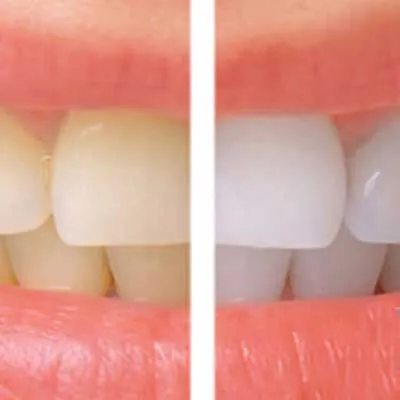 33895 teeth whitening aftercare