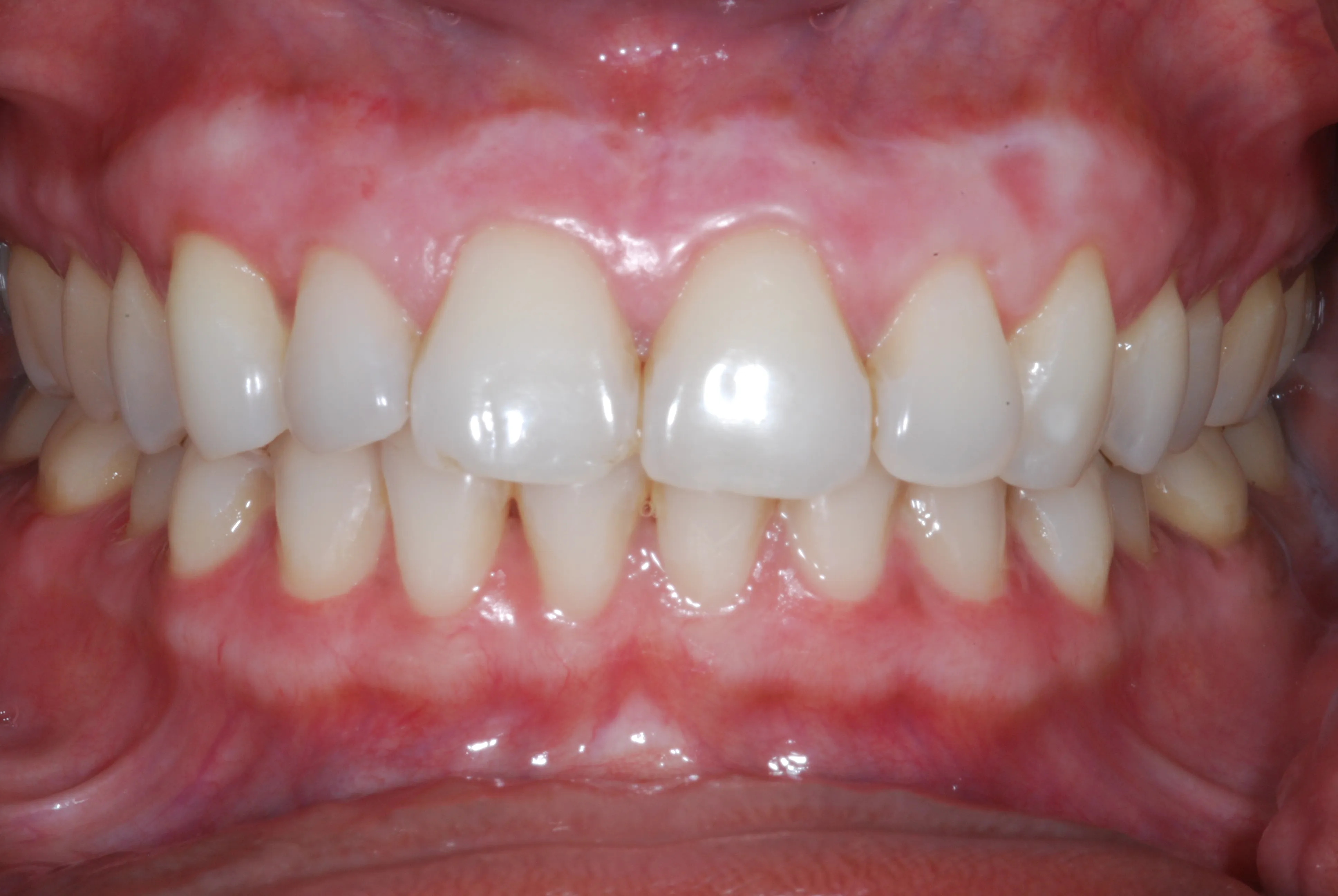 33898 white spots gums whitening 1