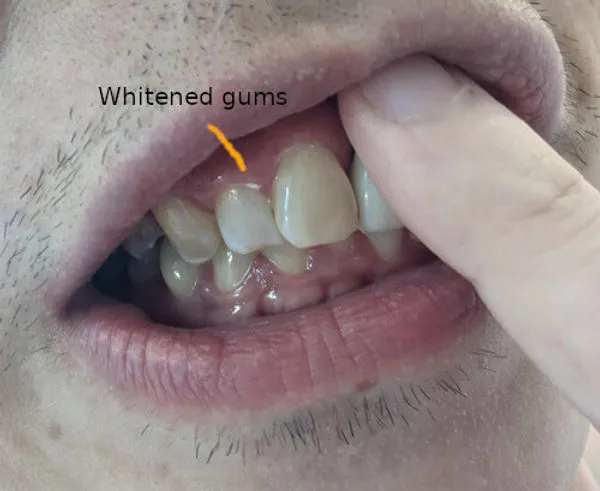 33898 white spots gums whitening 4