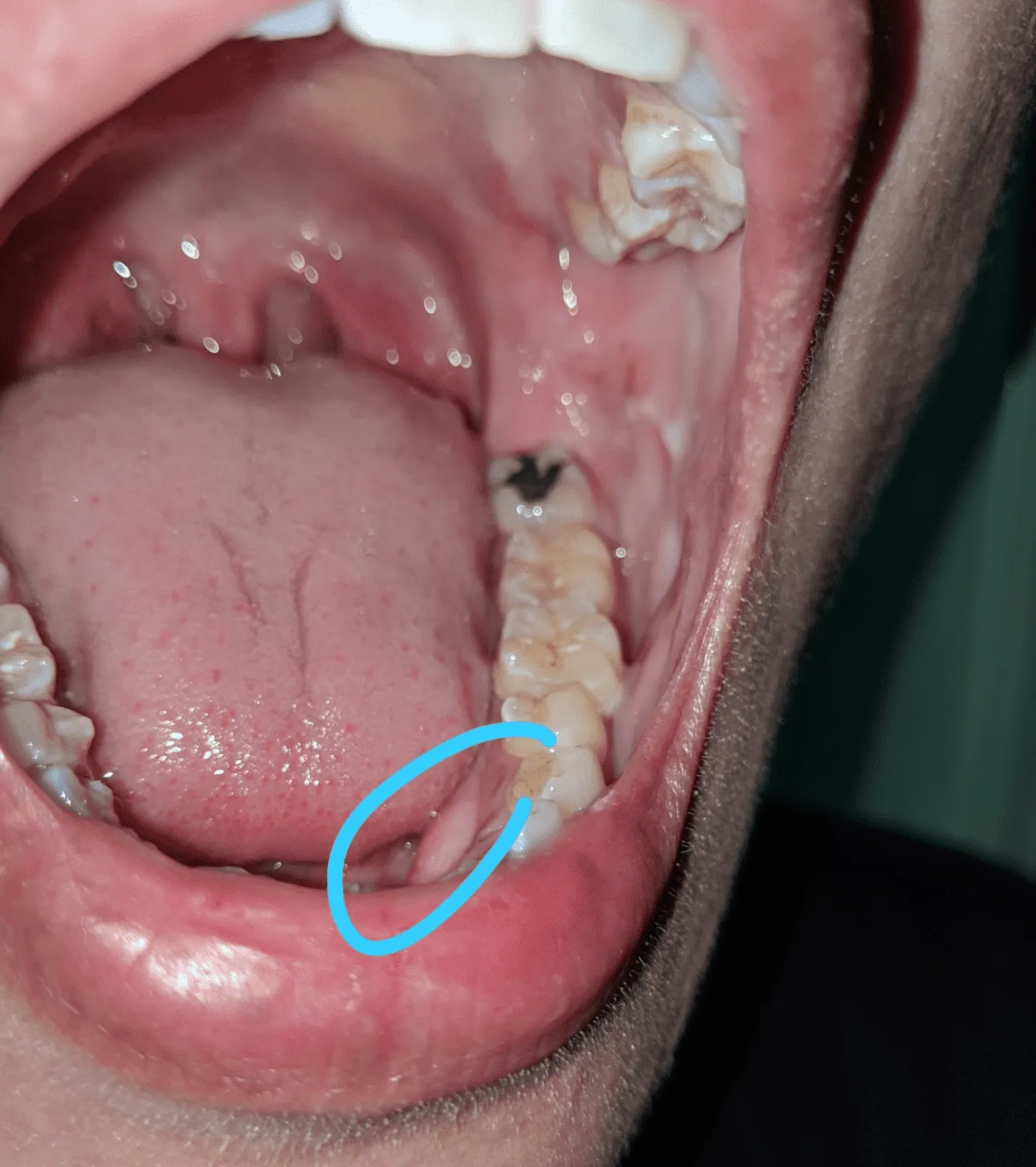 33898 white spots gums whitening 6