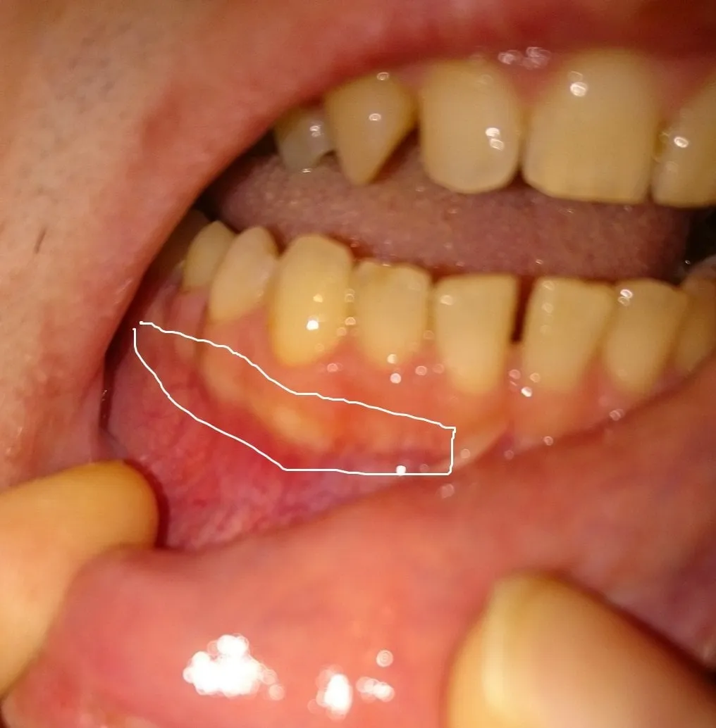 33898 white spots gums whitening 7
