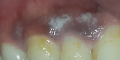 /img/33898-white-spots-gums-whitening-8.webp