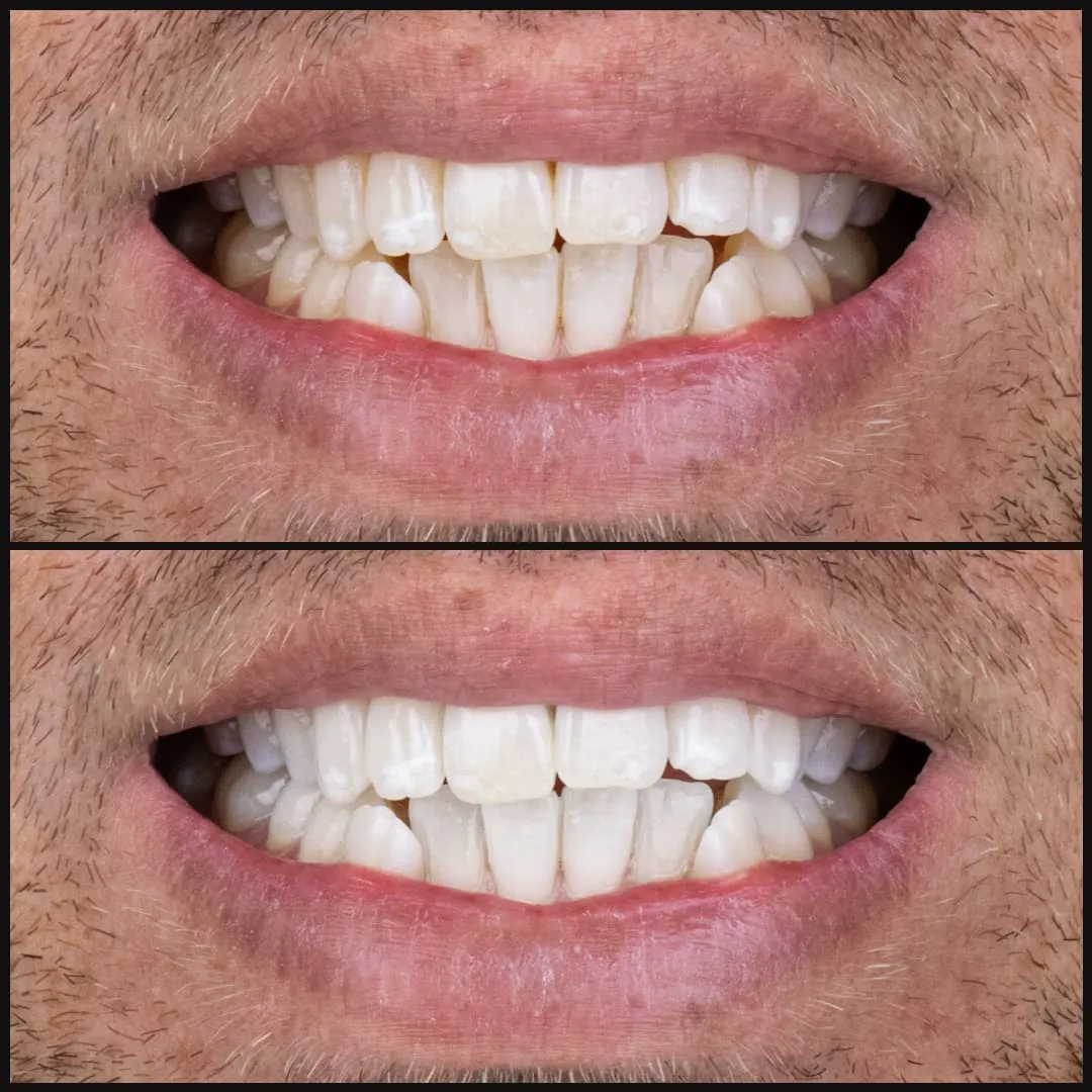 33904 in office bleaching