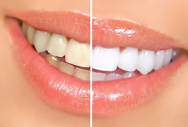 33913 sensitive teeth whitening